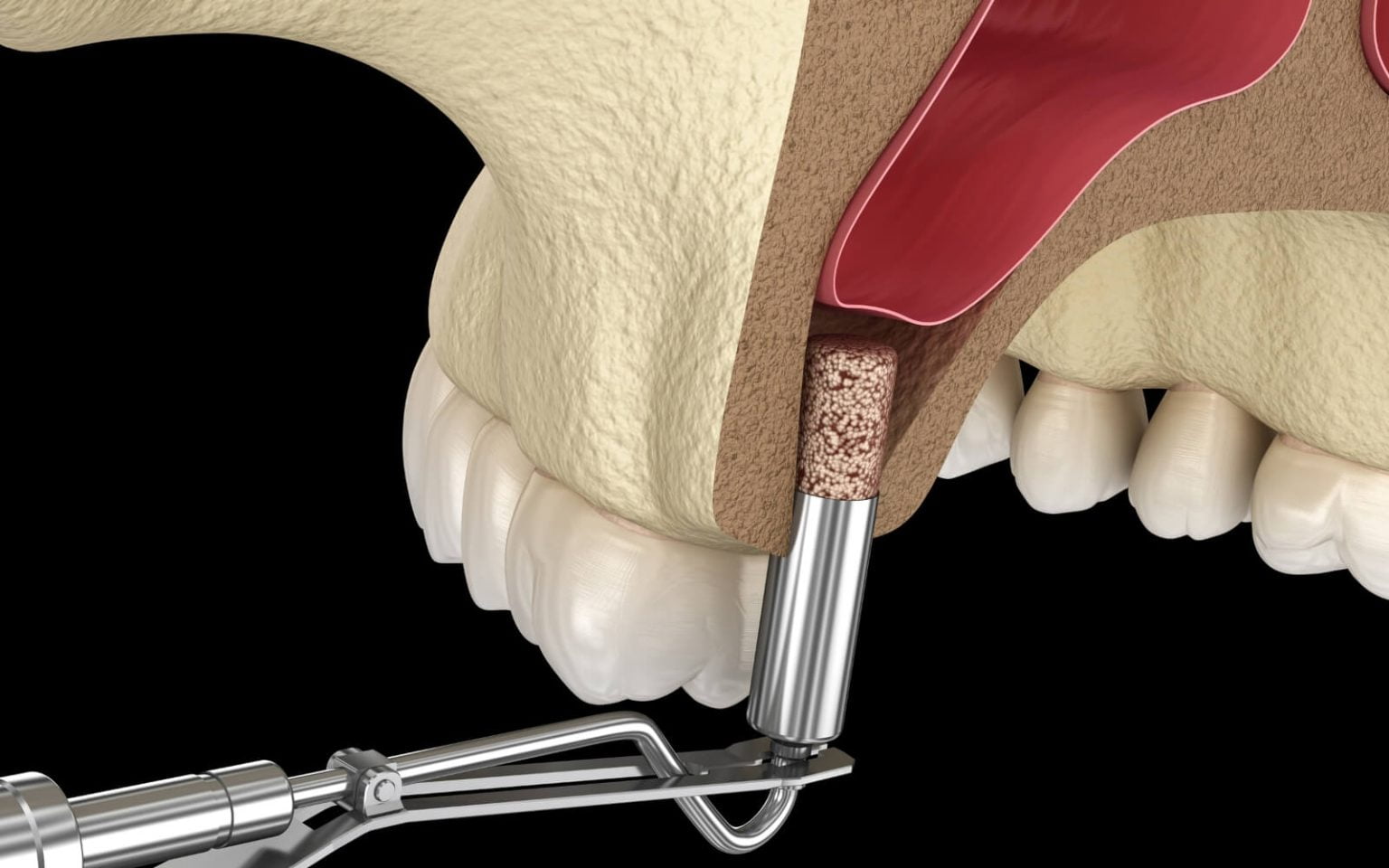 Bone Graft and Sinus Lift Artista Advanced Dentistry